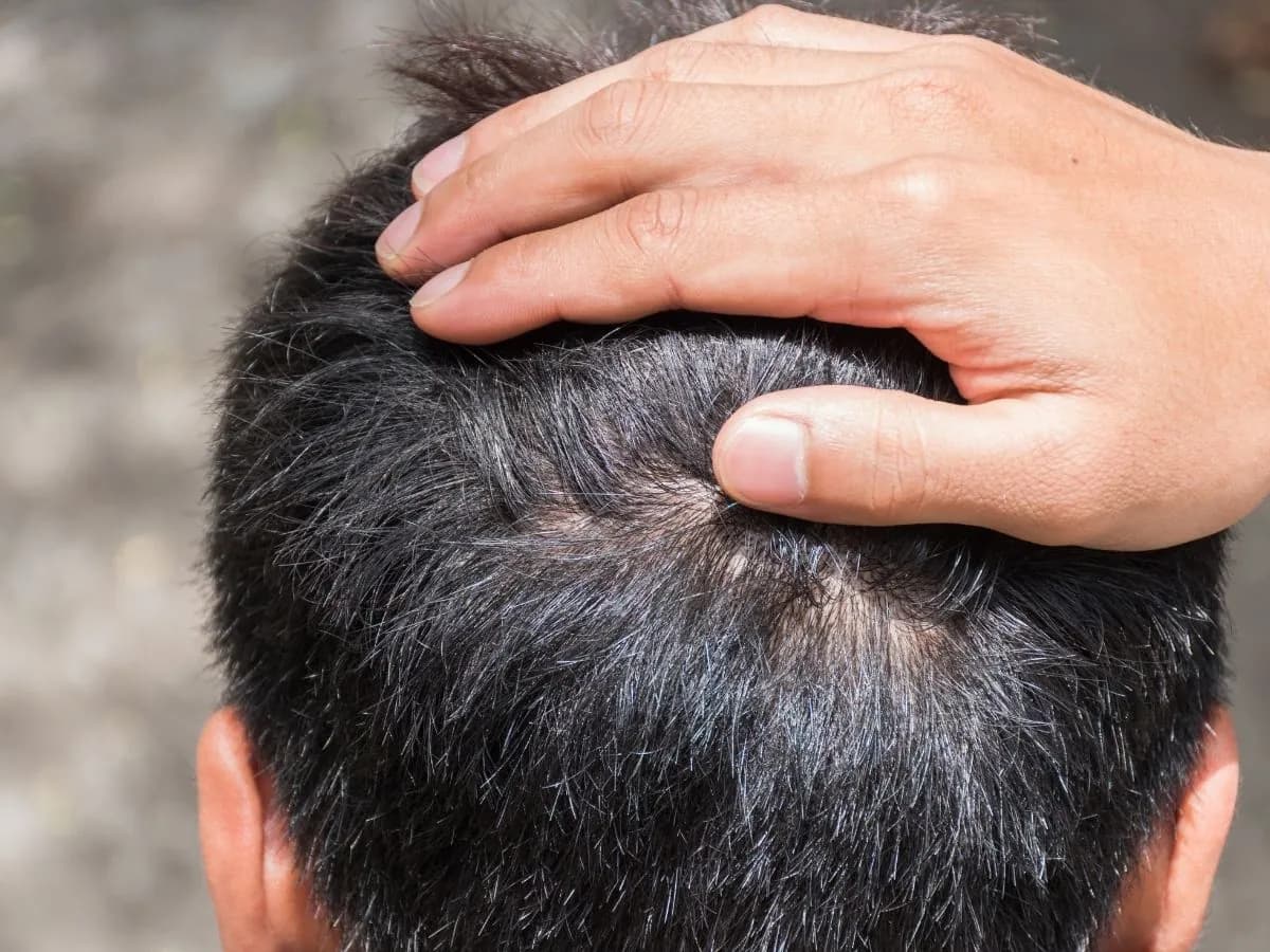 Finasteride Philippines: Uses, Side Effects, and How to Buy - andyou.ph